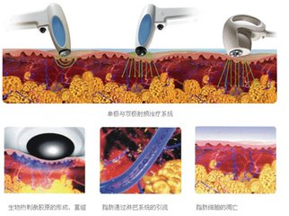 電波拉皮可以去除魚(yú)尾紋嗎?