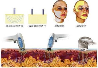 武漢電波拉皮除皺的效果怎么樣?