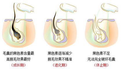 武漢冰點脫毛嗎?