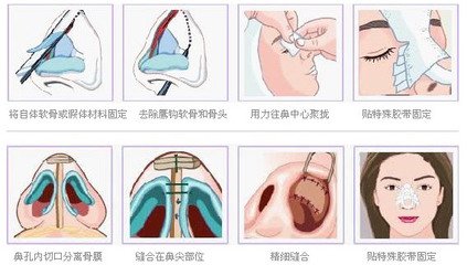 武漢隆鼻的費(fèi)用是多少?