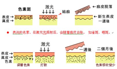 武漢激光祛雀斑效果持久嗎?