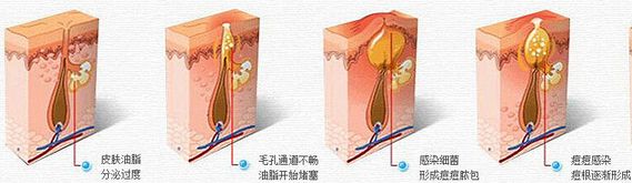 武漢怎樣去除痘印比較有效?