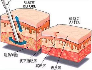 武漢腰部吸脂嗎?