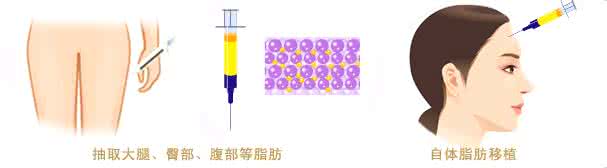 武漢自體脂肪豐額頭怎樣的?