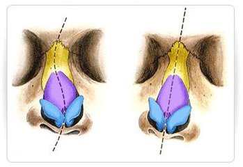 隆鼻后鼻子歪了怎么辦?