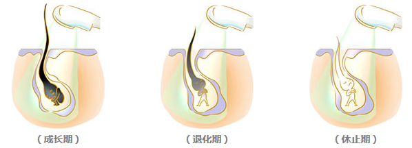 藝星激光脫毛多少錢(qián)?