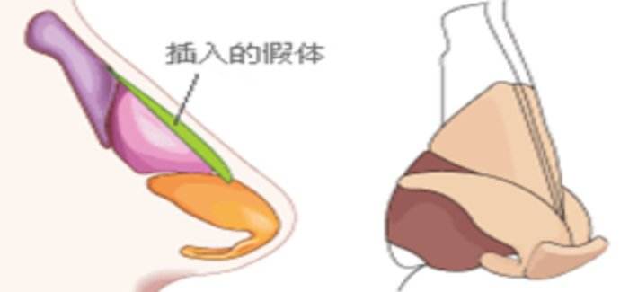 武漢韓式隆鼻嗎?