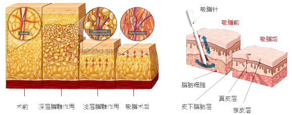 武漢手臂吸脂痛嗎?