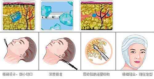 武漢面部吸脂多長時(shí)間可以恢復(fù)?