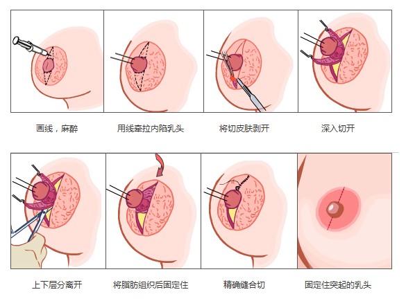 武漢有什么方法可以矯正乳頭內(nèi)陷?