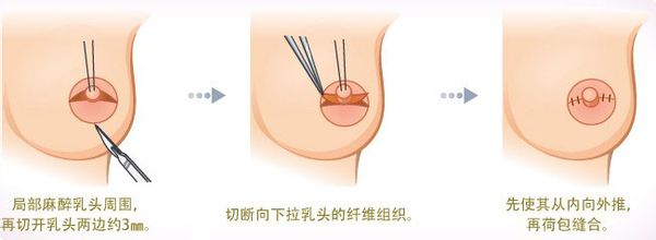 武漢做乳頭內(nèi)陷矯正手術(shù)嗎?