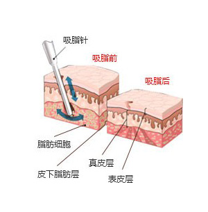 武漢背部吸脂效果怎么樣?