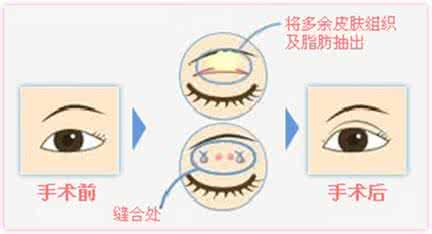 武漢雙眼皮的效果維持多久?