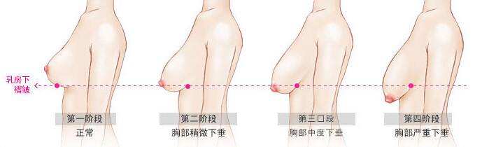 武漢哪些原因會(huì)造成乳房下垂