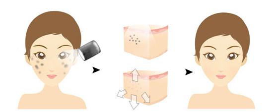 武漢皮秒祛斑是怎么操作的