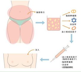 自體脂肪豐胸和假體豐胸有哪些區(qū)別?