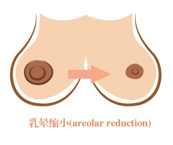 武漢乳暈過(guò)大需要怎么做