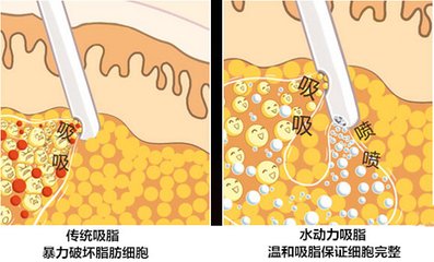 武漢水動力吸脂減肥的價格是多少?