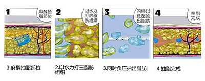 武漢水動(dòng)力吸脂減肥后還會(huì)反彈嗎?