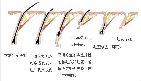 武漢冰點(diǎn)脫毛是的嗎