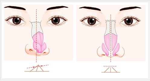 武漢不同歪鼻怎么矯正