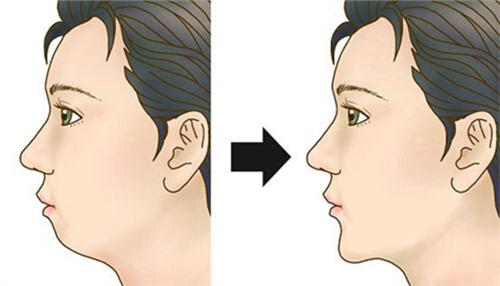 武漢通過(guò)隆下巴能改善臉型嗎