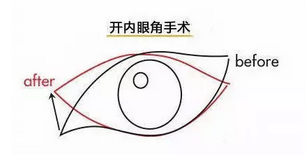 武漢內(nèi)眥開大術(shù)后需要拆線嗎