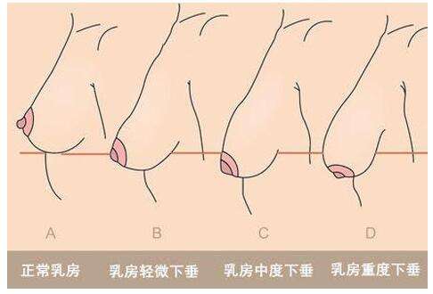 武漢乳房下垂有哪些原因