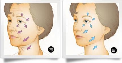 武漢電波拉皮是怎么除皺的