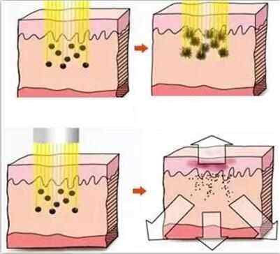 武漢激光祛斑的祛斑原理是什么