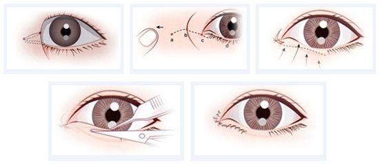 武漢哪些人適合開大內(nèi)眥手術(shù)