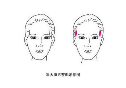 武漢填充太陽穴有哪些方法