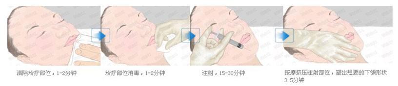 武漢下巴整形的方法有哪些