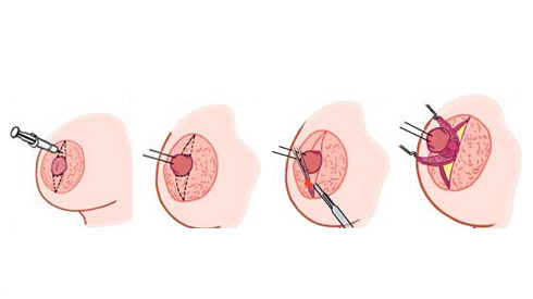 武漢乳頭內(nèi)陷矯正后怎么護理