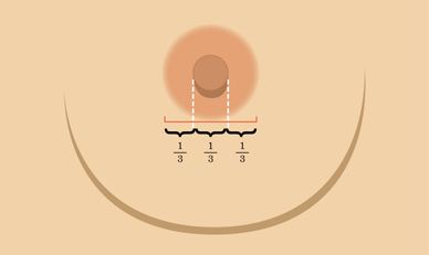 武漢乳暈手術(shù)有什么特點呢