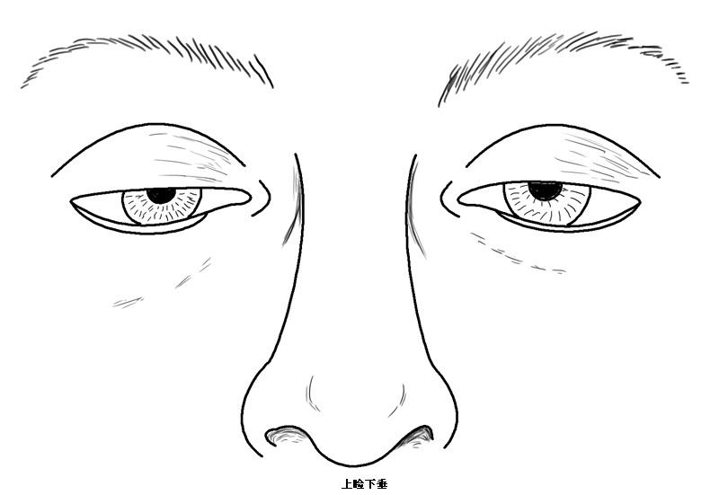 武漢怎么判斷有沒有上瞼下垂