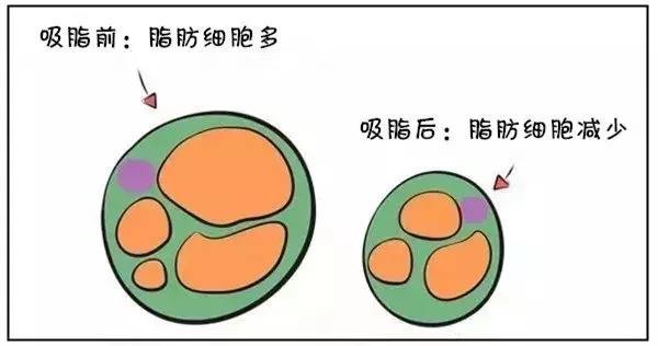 武漢腰腹吸脂會(huì)不會(huì)反彈