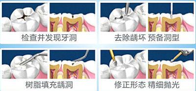 武漢怎么補牙