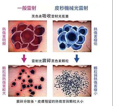 武漢超皮秒去黃褐斑疼嗎