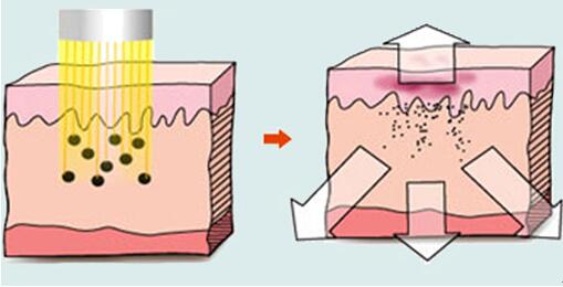武漢激光治療黃褐斑是什么原理